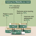 Aryanveda Anti Acne Oil Control Facial Kit for Glowing Skin