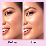 Recode Acne Patch Pack Of 36 Patches product image 3