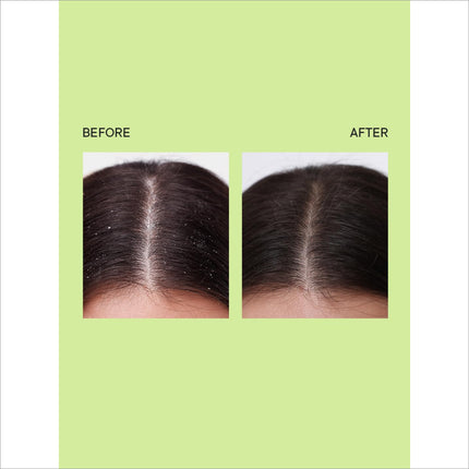 Before and after results of using Quench's Scalp Scrub for Dandruff, emphasizing its effectiveness in treating dandruff.